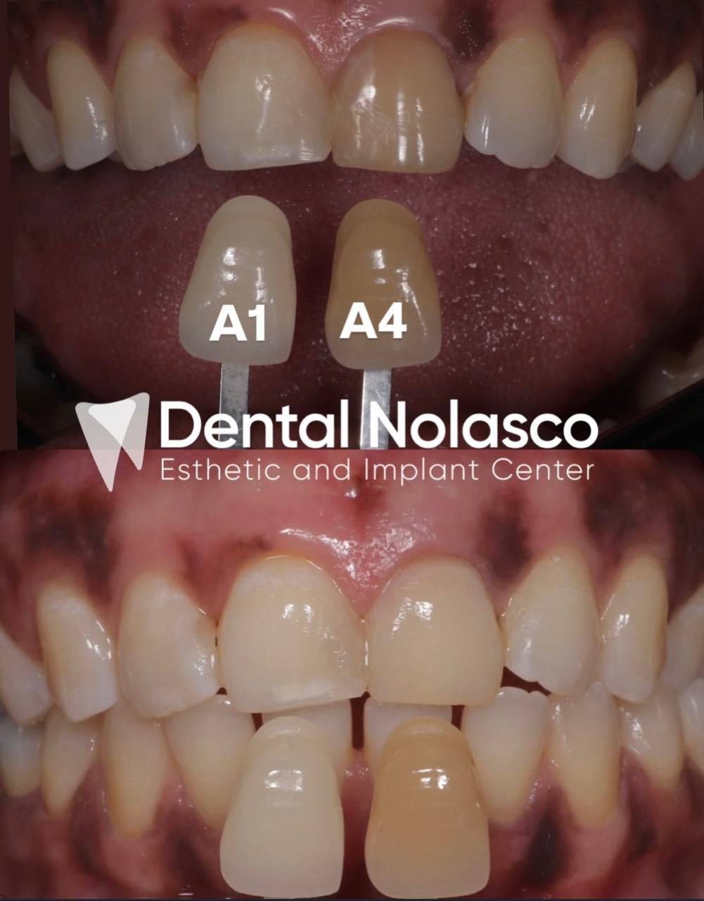 Antes y Después - Caso 3